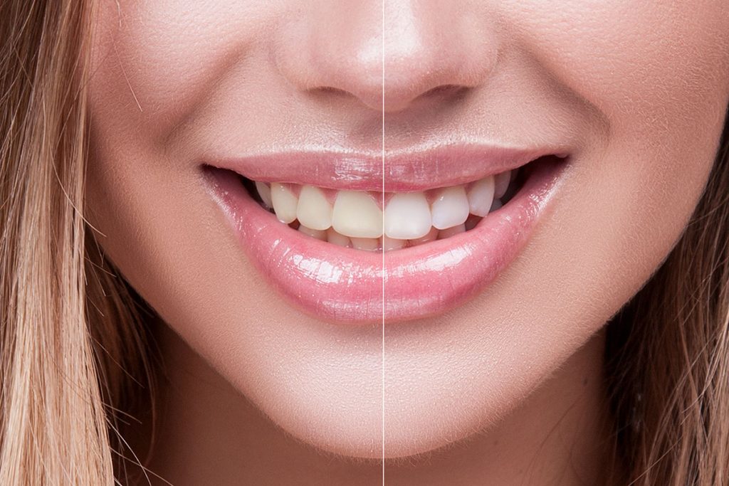 Teeth Whitening in Warren, MI | Folbe DDS